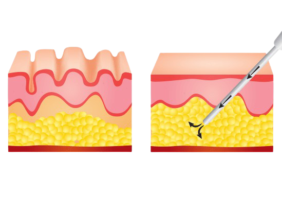 Operation of Auto-Fat Injection 1